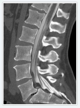 Myleogram Spine